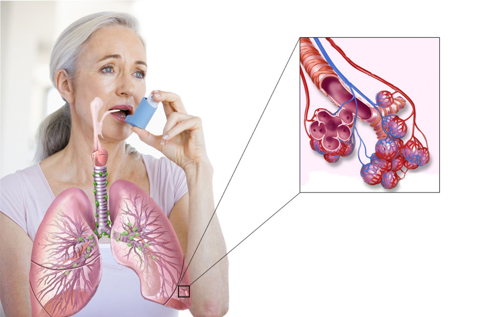 Хроническим заболеванием дыхательных. Бронхиальная астма. Инфекционно-аллергическая бронхиальная астма это. Заболевания дыхательной системы бронхиальная астма. Бронхит астма касаллиги.